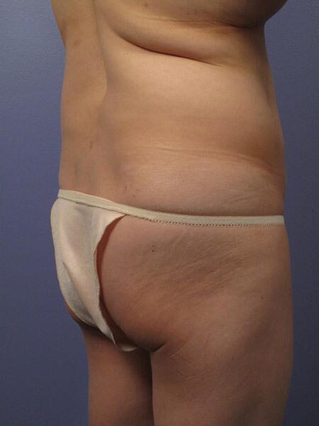 Liposuction Before & After Image