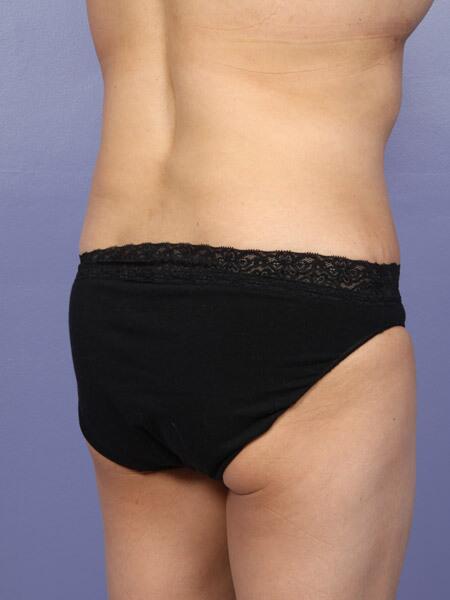 Liposuction Before & After Image