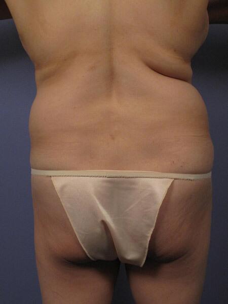 Liposuction Before & After Image