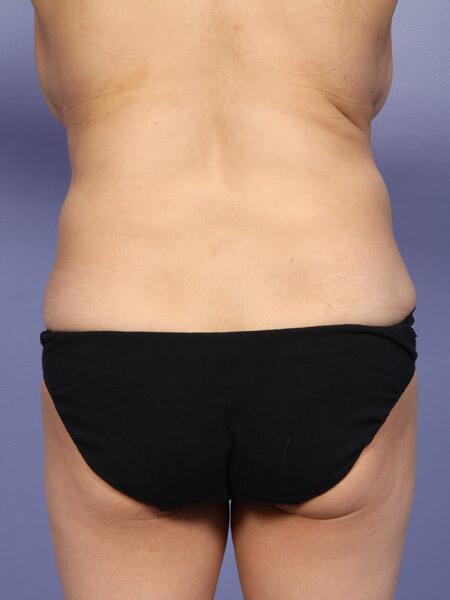 Liposuction Before & After Image