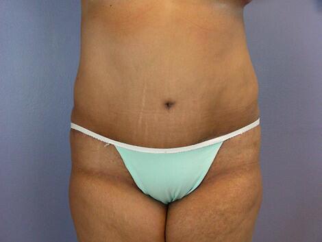 Liposuction Before & After Image