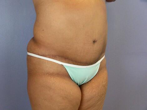 Liposuction Before & After Image