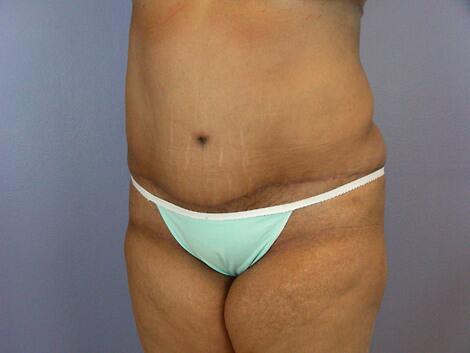 Liposuction Before & After Image