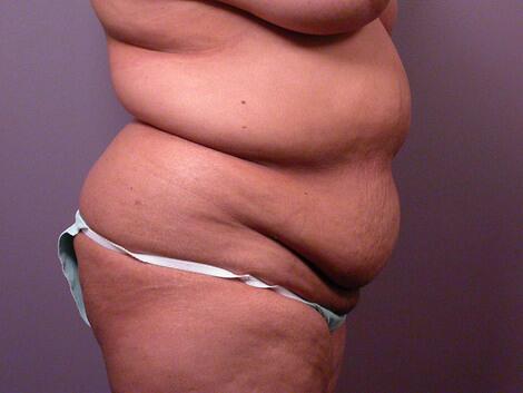 Liposuction Before & After Image