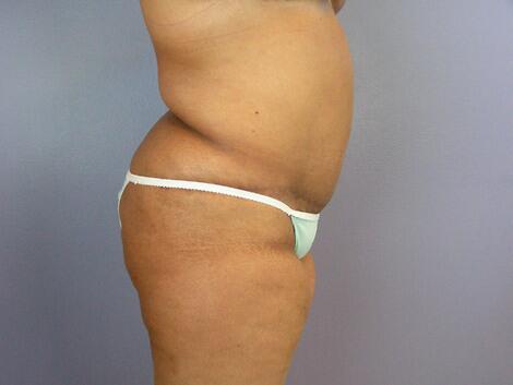 Liposuction Before & After Image