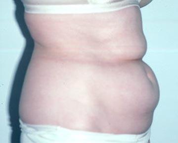 Liposuction Before & After Image