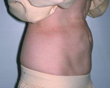 Liposuction Before & After Image