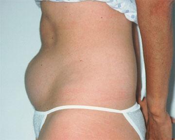 Liposuction Before & After Image