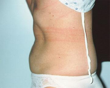 Liposuction Before & After Image