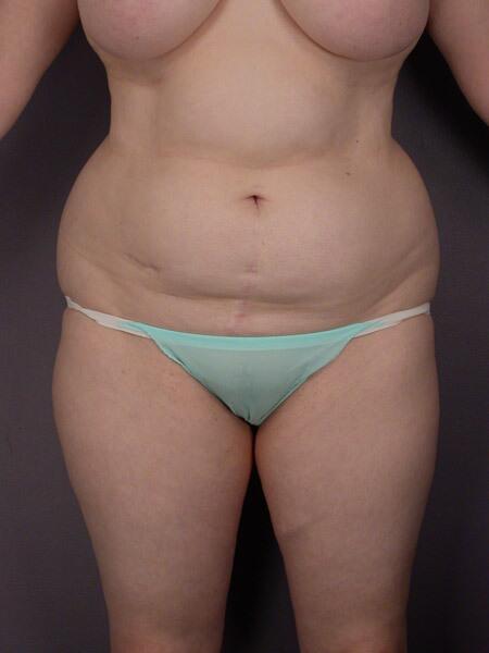 Liposuction Before & After Image