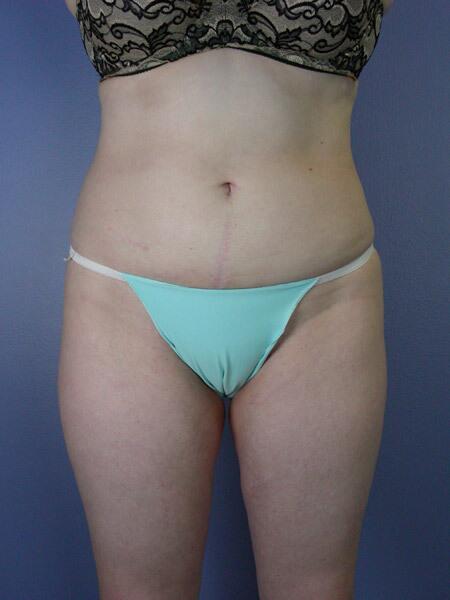 Liposuction Before & After Image