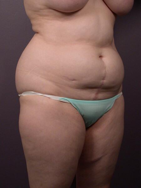 Liposuction Before & After Image