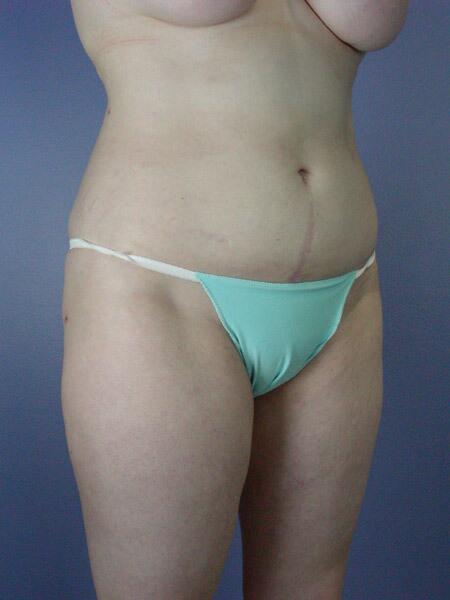 Liposuction Before & After Image