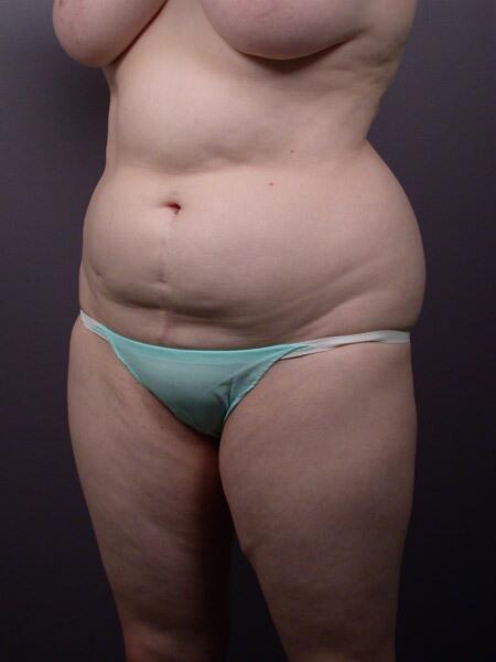 Liposuction Before & After Image