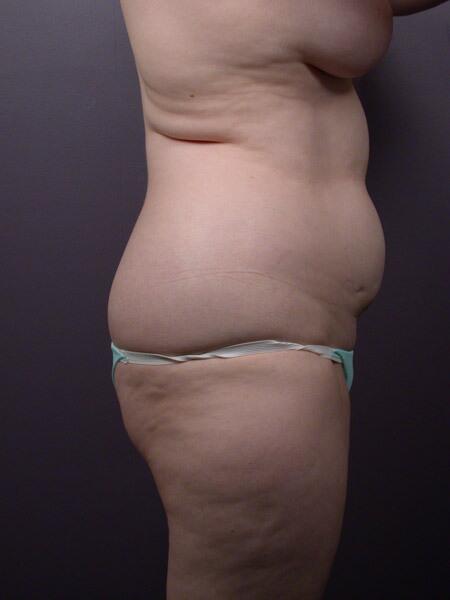 Liposuction Before & After Image