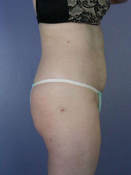 Liposuction Before & After Image