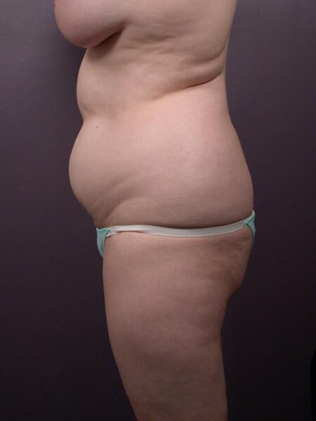 Liposuction Before & After Image