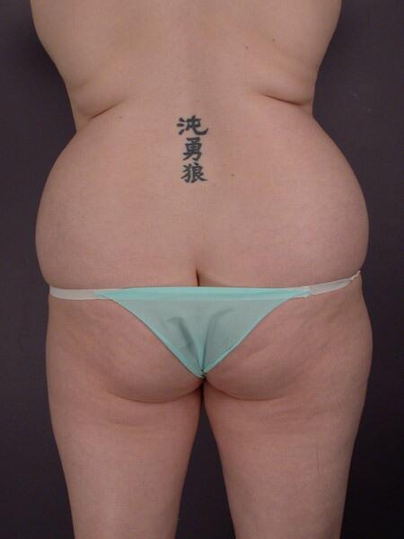 Liposuction Before & After Image