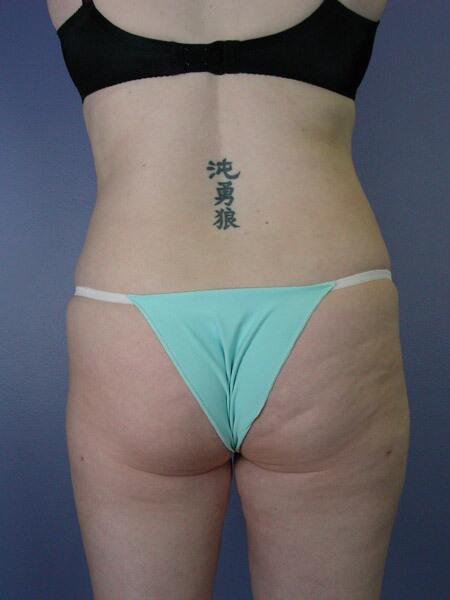 Liposuction Before & After Image