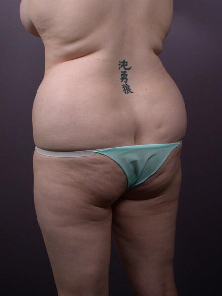 Liposuction Before & After Image