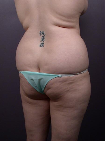 Liposuction Before & After Image