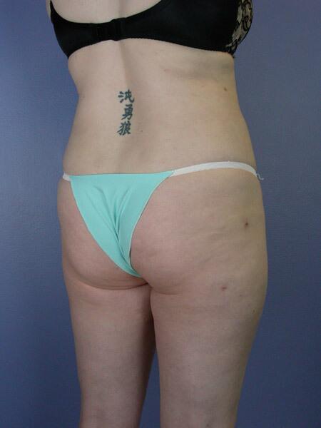 Liposuction Before & After Image