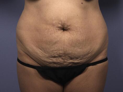 Liposuction Before & After Image