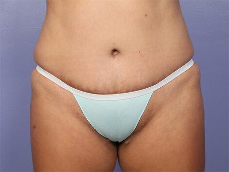 Liposuction Before & After Image