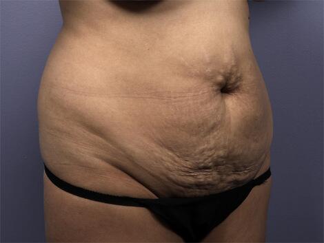 Liposuction Before & After Image