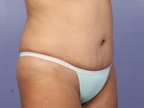 Liposuction Before & After Image