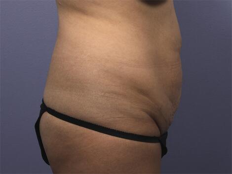 Liposuction Before & After Image