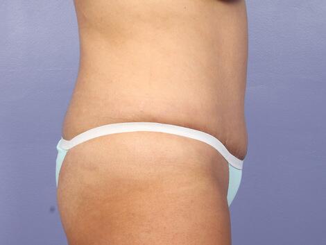 Liposuction Before & After Image