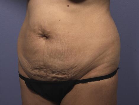 Liposuction Before & After Image