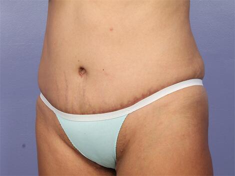 Liposuction Before & After Image