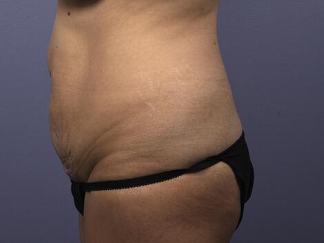 Liposuction Before & After Image