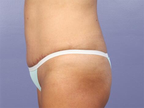 Liposuction Before & After Image