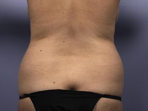 Liposuction Before & After Image