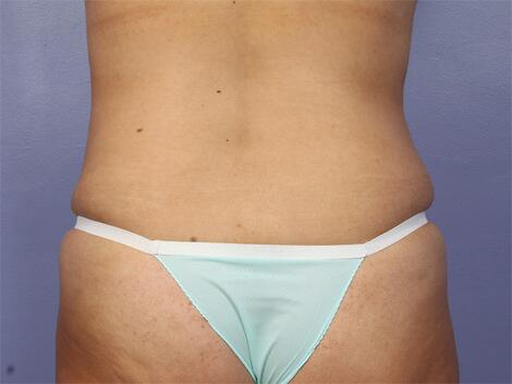 Liposuction Before & After Image