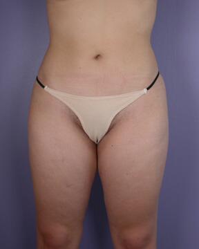 Liposuction Before & After Image