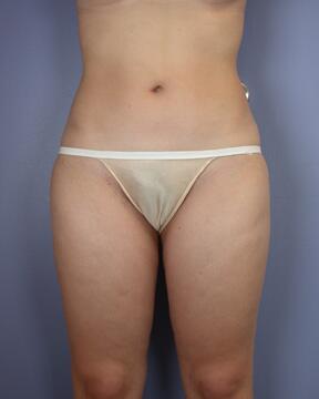 Liposuction Before & After Image