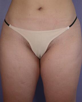 Liposuction Before & After Image