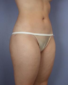 Liposuction Before & After Image