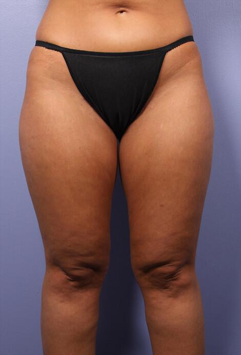 Liposuction Before & After Image