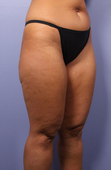 Liposuction Before & After Image