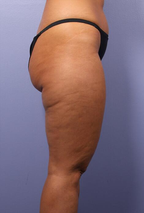 Liposuction Before & After Image