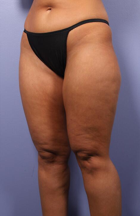 Liposuction Before & After Image