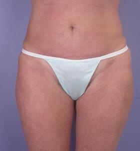 Liposuction Before & After Image