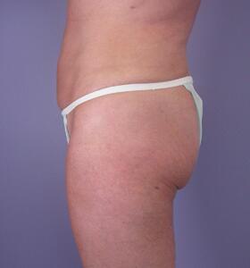 Liposuction Before & After Image