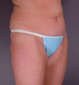 Liposuction Before & After Image