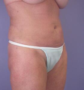 Liposuction Before & After Image